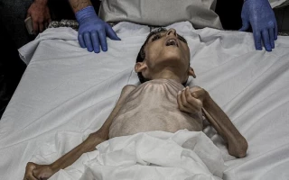 یک کودک فلسطینی در نتیجه سوء تغذیه جان داد