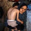 رنج کودکانه در سایه محاصره؛ «نجوی حجاج» قربانی سوءتغذیه و بیماری‌های پوستی در غزه 4